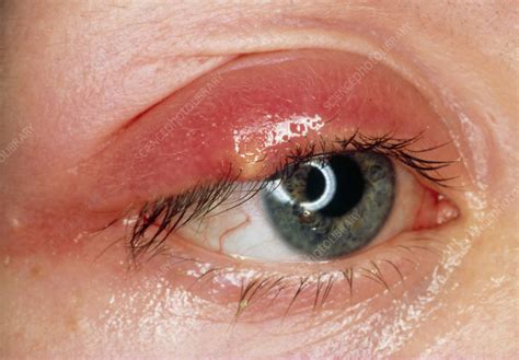 picture of a stye on upper eyelid