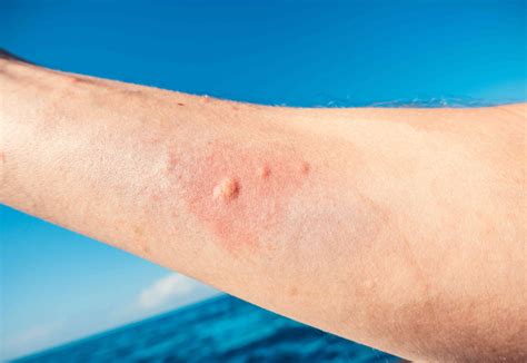 picture of jellyfish sting