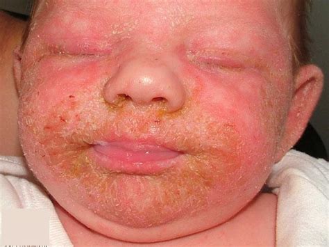 picture of seborrheic dermatitis