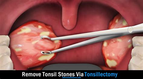 picture of tonsil stones removal