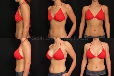 pictures of breast augmentation