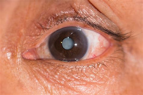 pictures of cataracts in humans