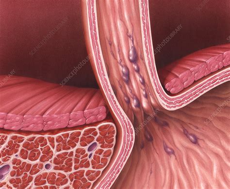 pictures of esophageal varices