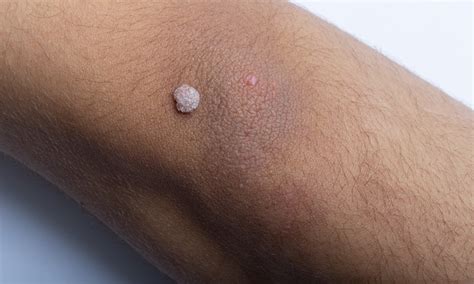 pictures of hpv warts on arms