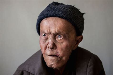 pictures of leprosy on face