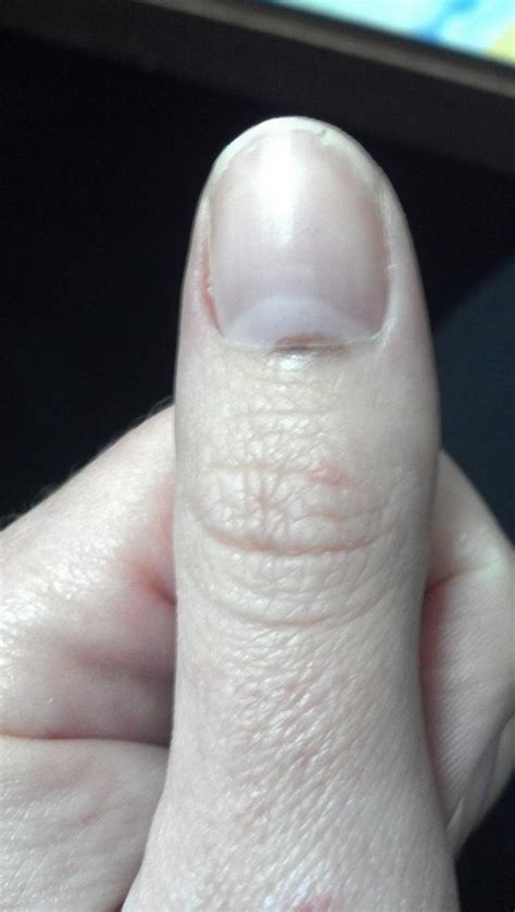 pictures of melanoma in fingernail bed