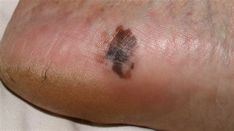 pictures of melanoma on feet