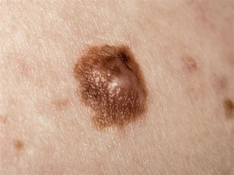 pictures of melanoma on skin