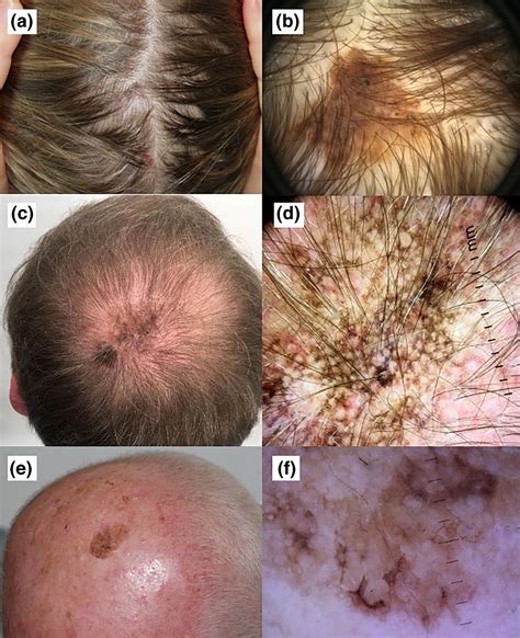 pictures of melanoma skin cancer on scalp