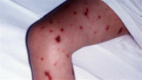 pictures of meningococcal rash