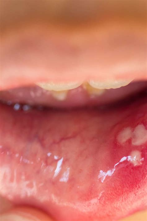 pictures of oral hpv warts