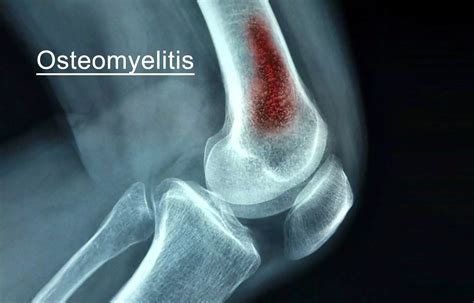 Pictures of osteomyelitis