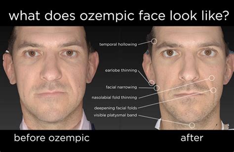 pictures of ozempic face
