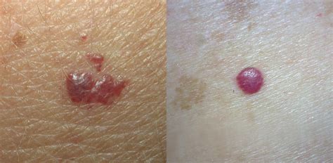 pictures of pink melanoma