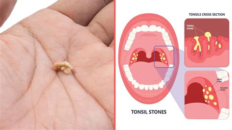 pictures of tonsil stones pictures