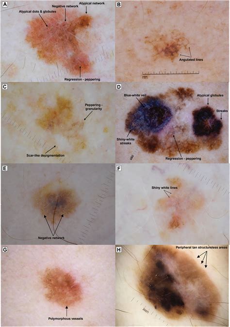 pictures of white melanoma