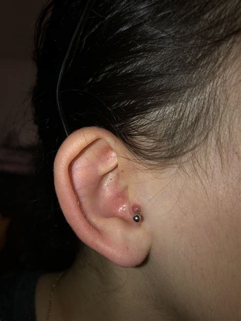 Piercing Keloid Removal Reddit