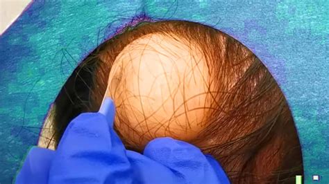 Pilar Cyst Pop: What You Need to Know