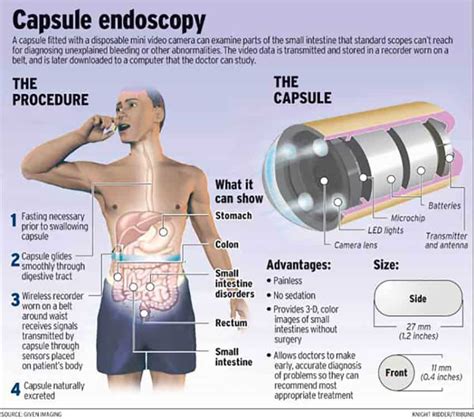 Pill Endoscopy Cost