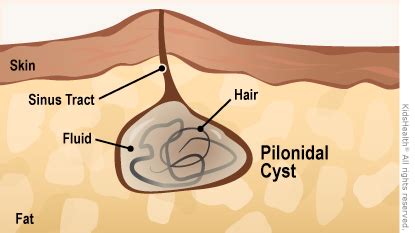 Pilonidal Cyst Image