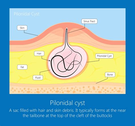 Pilonidal Cyst Causes Image
