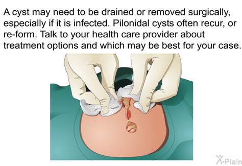 Effective Pilonidal Cyst Drainage: What You Need to Know