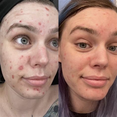 pimple for 3 weeks reddit