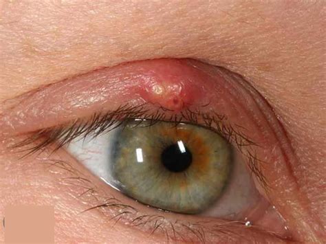 What Causes a Pimple in Eye and How to Treat It Effectively