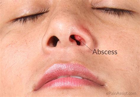 pimple inside nose causing swelling