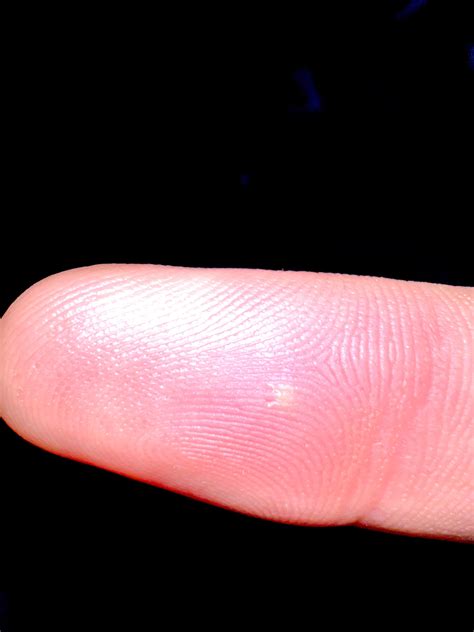 What Causes a Pimple on Finger and How to Treat It