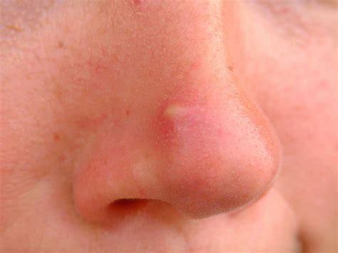 pimple on nose causing swelling