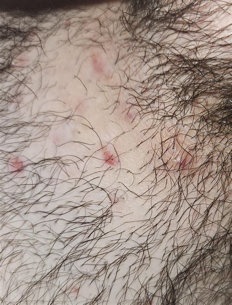 Pimple on Pubic Area: Causes, Treatment, and Prevention Tips