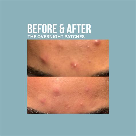 Pimple Patches Before or After Skincare The Ultimate Guide