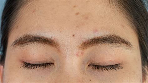 Acne between eyebrows Causes, Treatment, and Prevention MFine