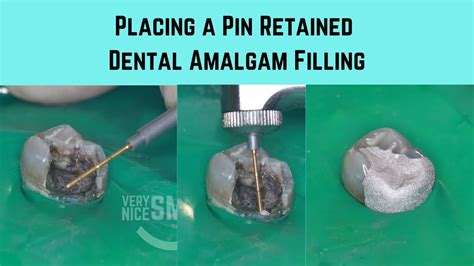 Pin For Tooth Filling