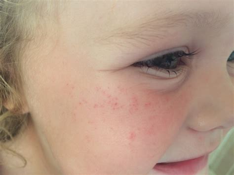 pin prick rash on child's cheeks