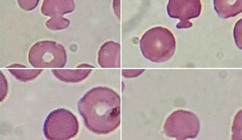Mushroomshaped red blood cells (pincer cells) a brief