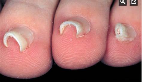 Typical appearance of pincer nail. Transverse