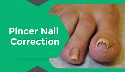 Pincer Nail Correction Cause Ftempo