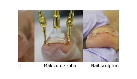 Figure 3 from Correction of pincer nail deformity with