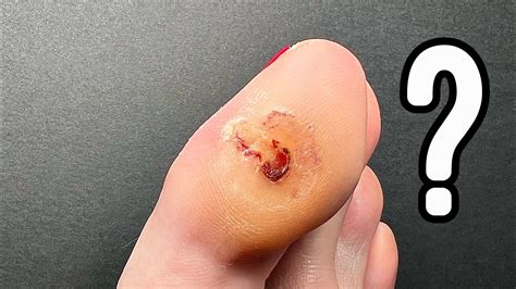 Pinch Callus Big Toe