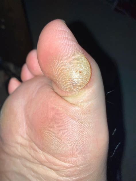 Pinch Callus Big Toe Reddit