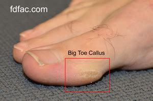 Pinch Callus Big Toe Running