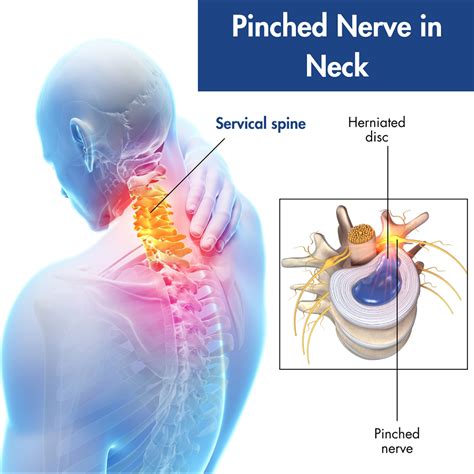 Pinched Nerve Neck Relief: Causes, Symptoms, and Effective Treatments
