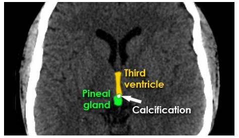 Pineal Gland Calcification Ct Unenhanced CT Scan. Hyperdense Lesion (4 ϫ 5 Cm) With
