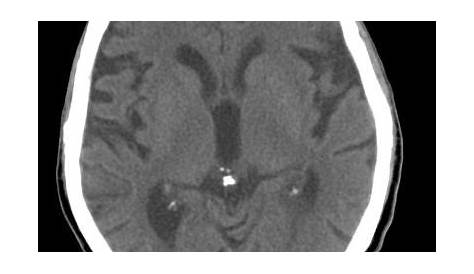 Pineal gland calcification Radiology Case