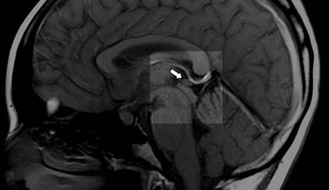 Pineal Gland Calcification Study Region Metastasis Radiology Case