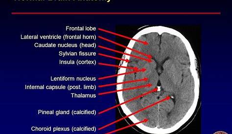 Pineal Gland Ct Brain Cyst Radiology Case Radiology
