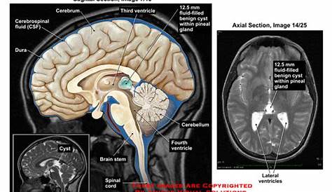 Pineal Gland Cyst Symptoms Mayo Clinic Can Growth Hormone Deficiency Be Cured? Pain Causing