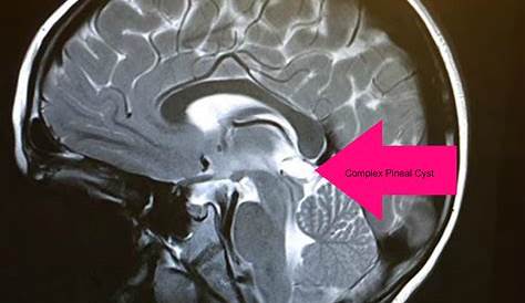 Pineal Gland Location Mri MRI Of Paediatric Brain Demonstrates Presence Of A